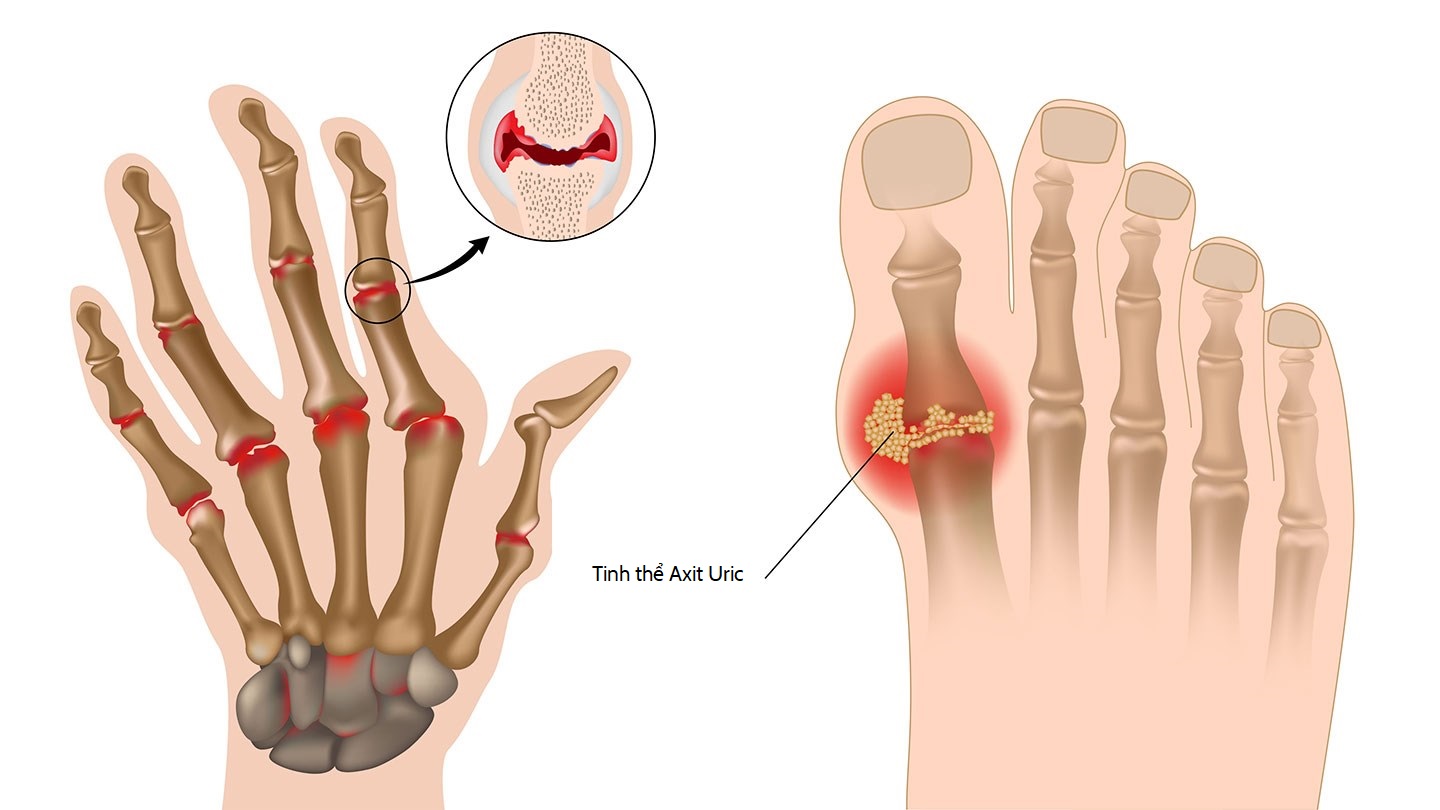 Nguyên nhân gây bệnh gout